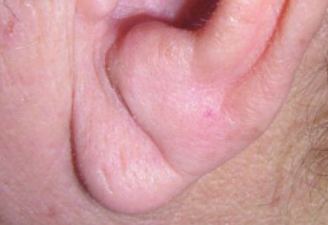 Pliegue en el lóbulo de la oreja